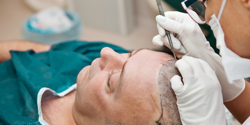 Hair Transplant Turkey: Transform Your Look with Experts